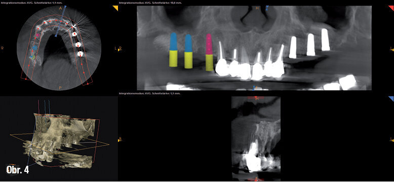 Ukázka plánování implantátů pomocí dentálního CT
