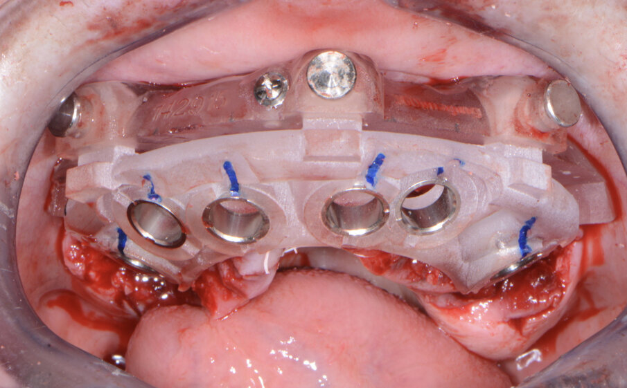 Fig. 9: Maxillary implant surgical guide.