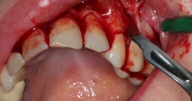 Przedprotetyczne postępowanie chirurgiczne z wykorzystaniem autologicznych preosteoblastów hodowanych in vitro