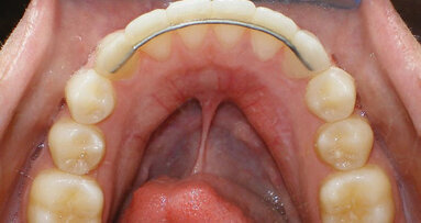 Reliance introduces newest addition to its lingual retention line: Extend LTR