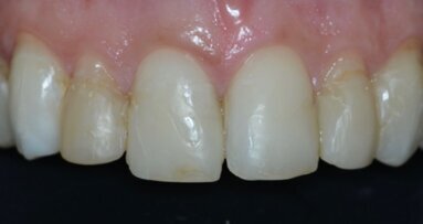 Riabilitazione estetica-funzionale del settore anteriore tramite full-veneers