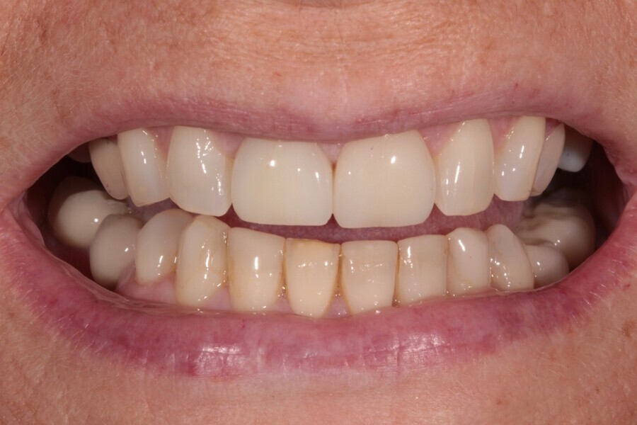 Fig. 9: 2017—the mandibular teeth starting to wear.