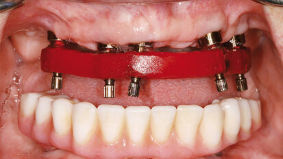 Nepřímá metoda pro ošetřování prostřednictvím provizorií