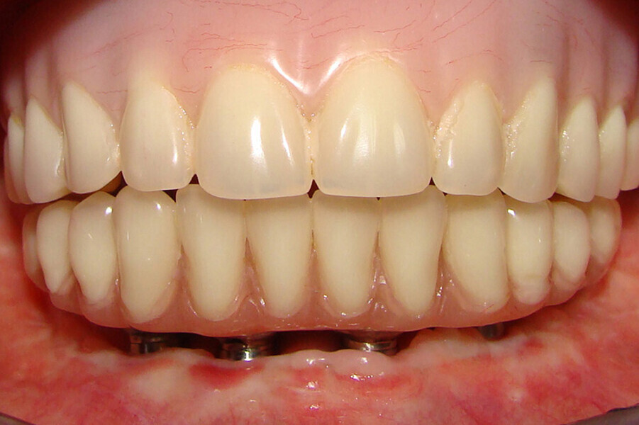 Fig. 12. Prótesis híbrida inmediata con 6 años de evolución y Rx Control a los 6 años.