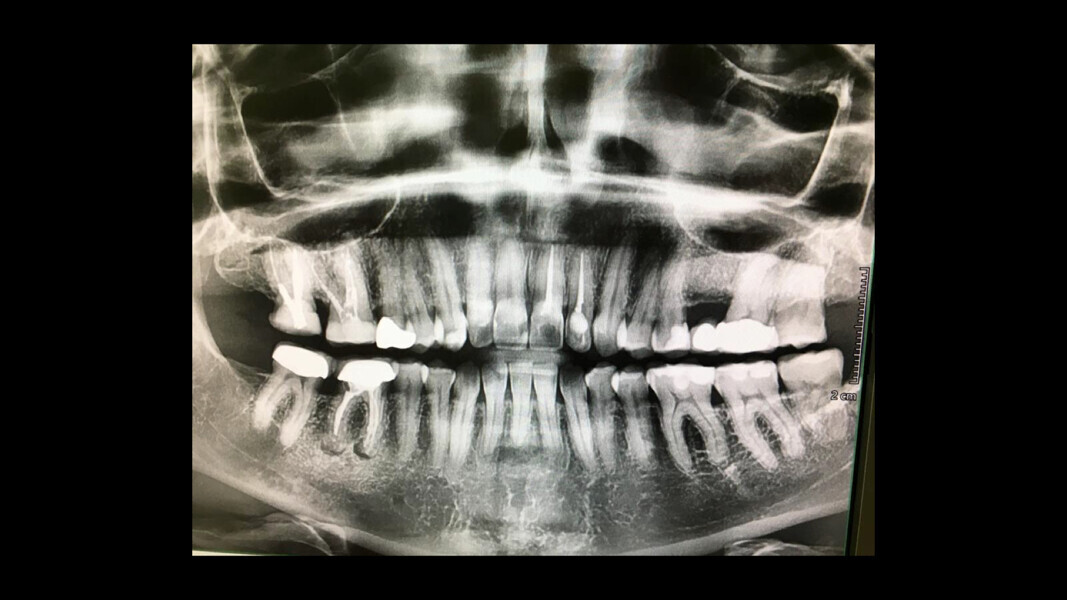 7: Panoramic radiograph showing a minor apical infection of the mandibular right first molar and endodontic treatment.