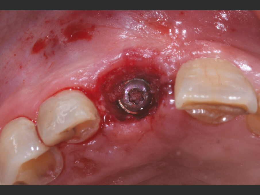 Fig. 4a - Impianto inserito lontano dalla corticale ossea vestibolare in modo da creare un gap superiore a 2 mm.
