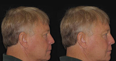 Проучване: не е нужно пациентите да правят компромис с външния си вид при избор на протеза