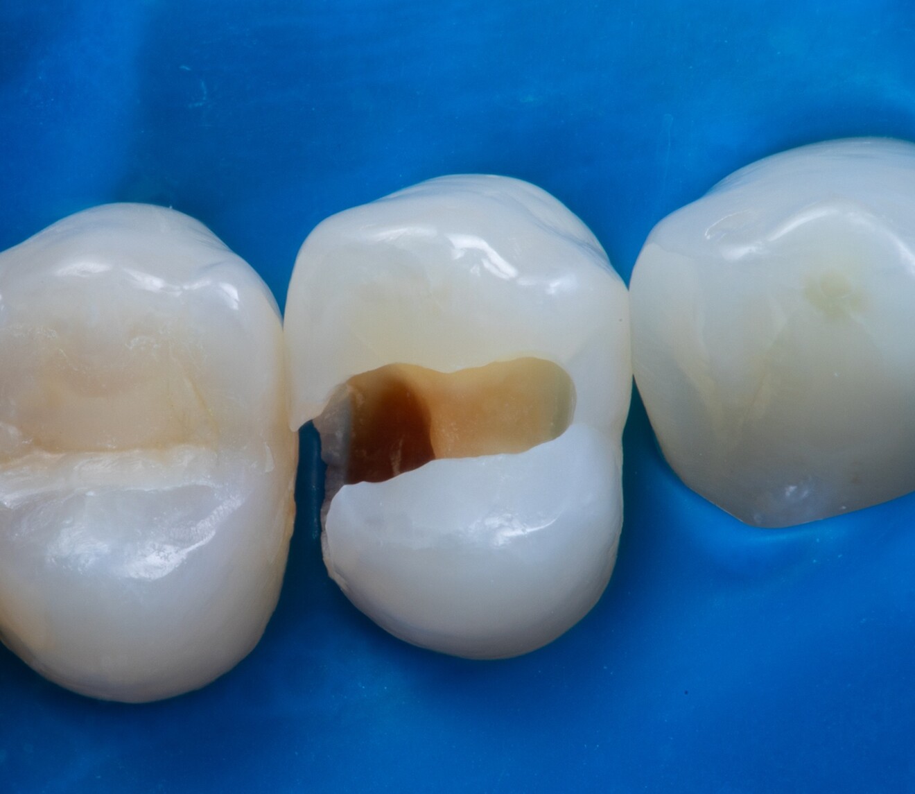 Fig. 1b: Preparation. 