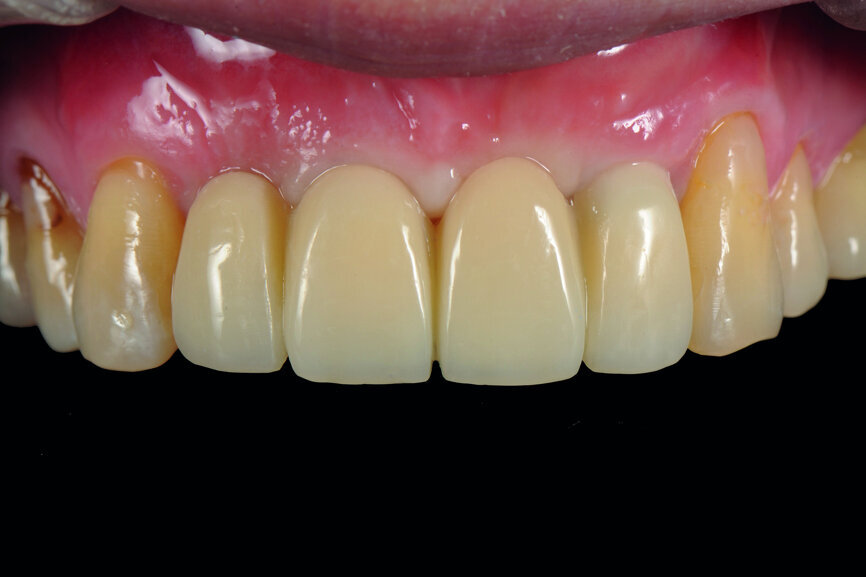 Fig. 18: Frontal view of the provisional restoration just after delivery.