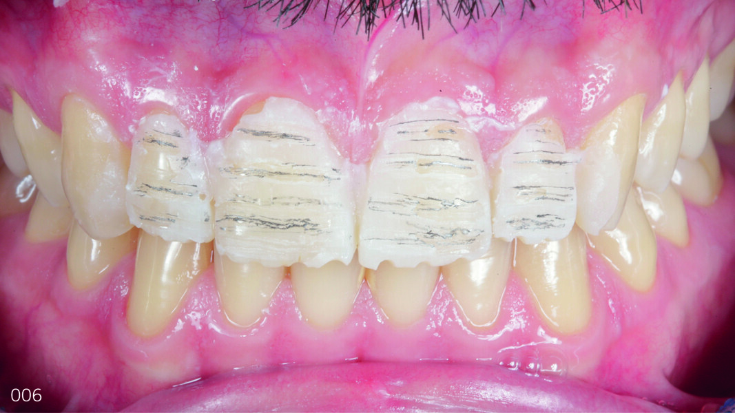 Fig. 6: Guide grooves marked with pencil for calibrated preparation primarily on the composite.