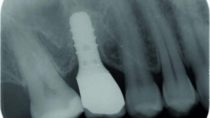 Grande rialzo del seno con impianto contestuale