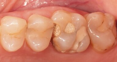 Лечение с Bio-Bulk fill при дълбоки кариеси