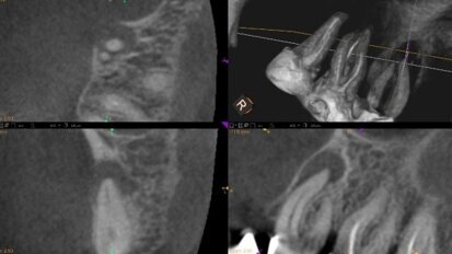 Precyzyjna ocena obecności, lokalizacji i rozmiaru zmian okołowierzchołkowych z wykorzystaniem CBCT