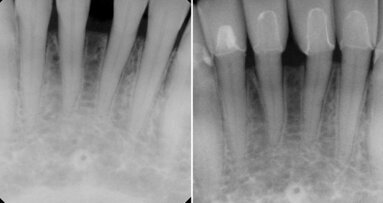 The importance of gingival health in a functional cosmetic case The importance of gingival health in a functional cosmetic case