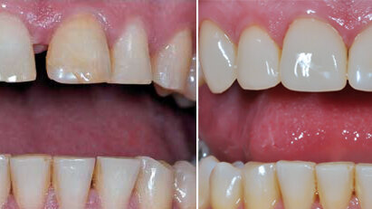 Carillas prefabricadas en dientes anteriores