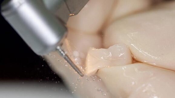 Inlay-Restauration:  Experte erläutert Anwendungsmöglichkeiten