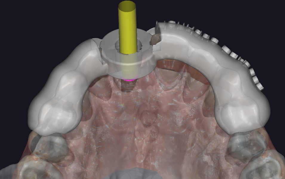 Fig. 9a: Virtual surgical guide design in exoplan with a sleeve for implant placement, palatal view.
