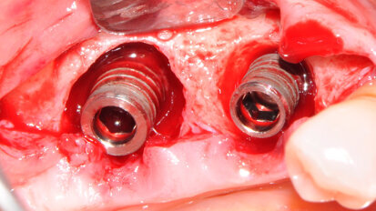 Trattamento di periimplantite: rigenerazione con l’utilizzo di un sostituto a lento riassorbimento