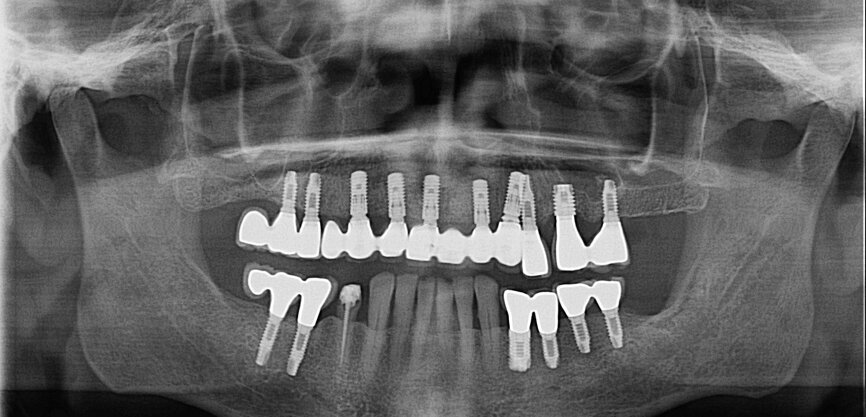 Fig. 13: Dental panoramic tomogram showing superstructure.