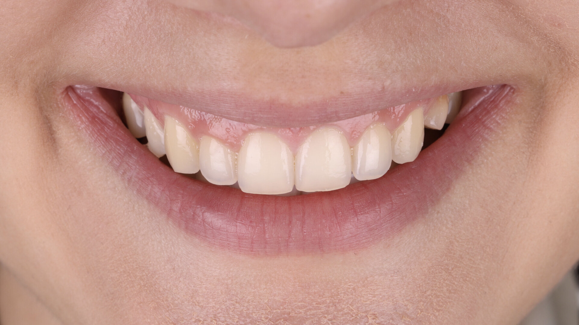 3D-printing inlays, onlays and overlays with SprintRay: A revolutionary approach to dental restorations