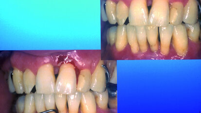 Die 2-Schritt-Therapie bei schwerer Parodontitis Die 2-Schritt-Therapie bei schwerer Parodontitis