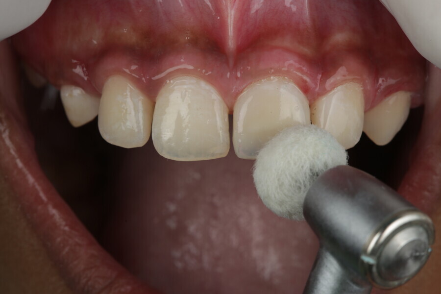 Fig 38: Buff was used for the final glass-like finish and polished at high speed with irrigation.