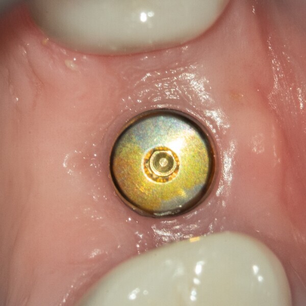 Fig. 2a: Restoration of the edentulous site. Occlusal view of the implant site with the healing abutment in place at the end of the healing period.