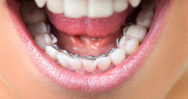 Study finds Saudi Arabians prefer lingual brackets and clear aligners
