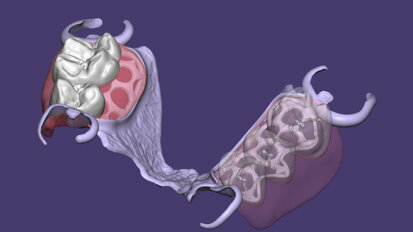 Exocad releases PartialCAD 3.1 Rijeka with 22 new functionalities Exocad releases PartialCAD 3.1 Rijeka with 22 new functionalities