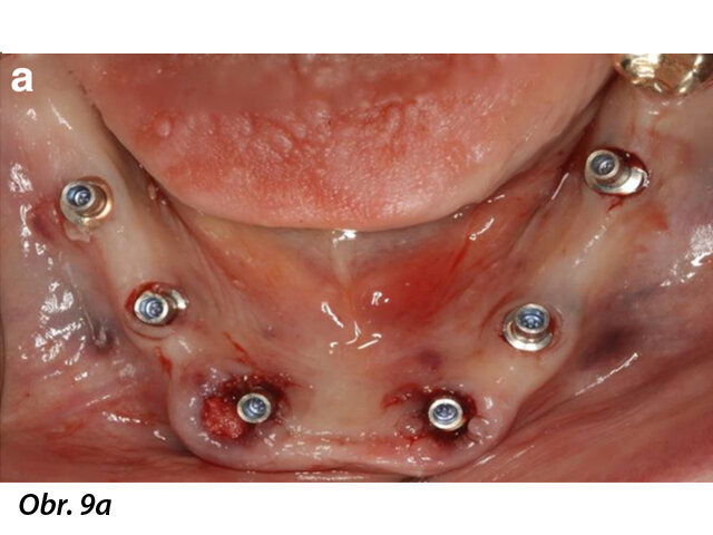 Okluzální pohledy na abutmenty (a) a okamžitě umístěnou provizorní náhradu, která byla připevněna in situ pasivně (b).