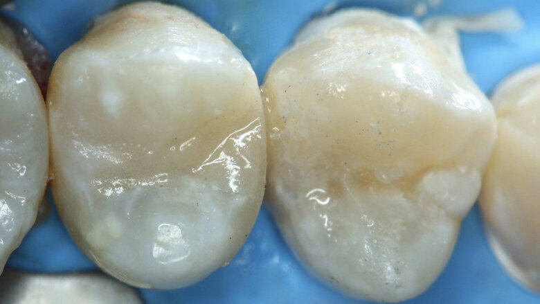 Figuras 29 y 30. Se inyecta el ionómero en la pieza 25.