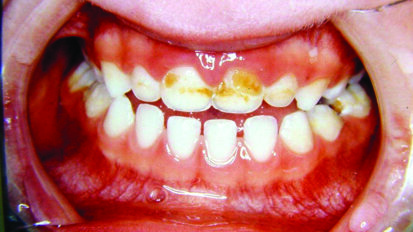 Early Childhood Caries: A Continuing Epidemic Oral Health Problem in the United Arab Emirates