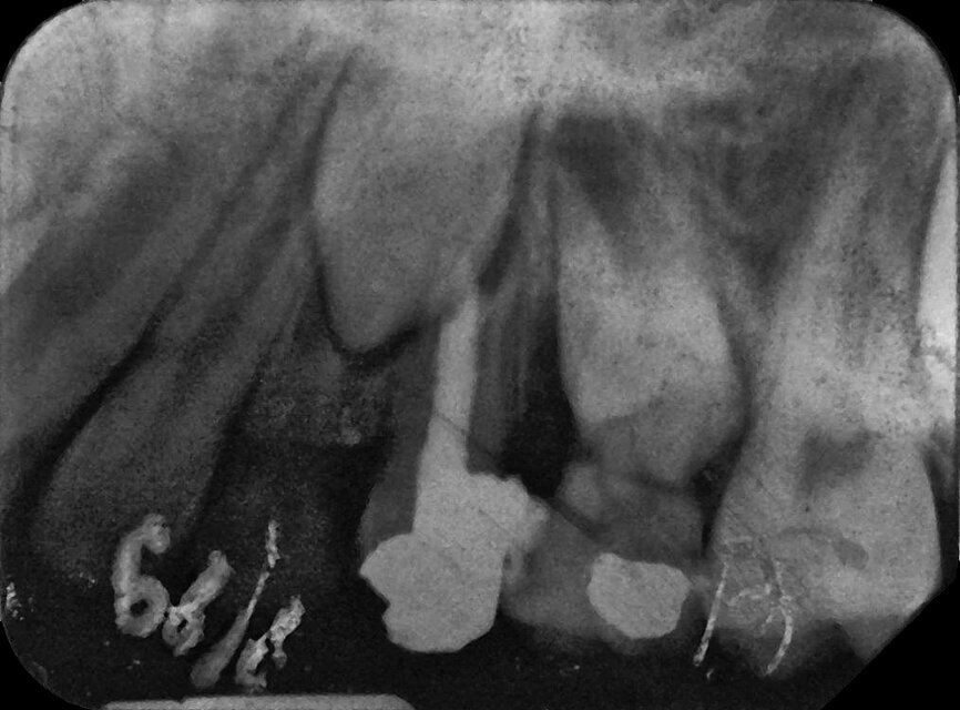Case 2: Male (born
28 December 1980): Tooth 14
Fig. 4b: 18 August 1989 post vitalextirpation.
