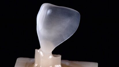 Fig. 3. El resultado de alta precisión tras el proceso de fresado con CEREC MC XL.