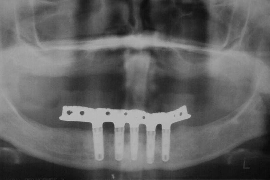 Fig. 9. Rx Pre-operatoria, Prótesis híbrida inmediata con 10 años de evolución y Rx Control a los 10 años.