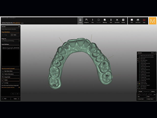 Při použití titanových základen K80 ASC jsou kanály pro šroubky v náhradě vidět na okluzních ploškách, což nijak neovlivňuje estetiku výsledné náhrady.