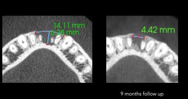 Promovisanje prirodnog vertikalnog rasta kosti - nije mit već stvarnost