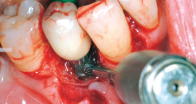 Mario Roccuzzo: quando e come trattare le complicanze perimplantari