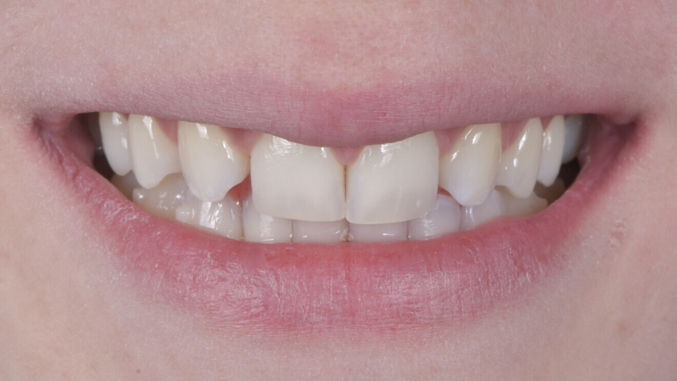 Fig.  5 : Situation finale à l’échelle du sourire.