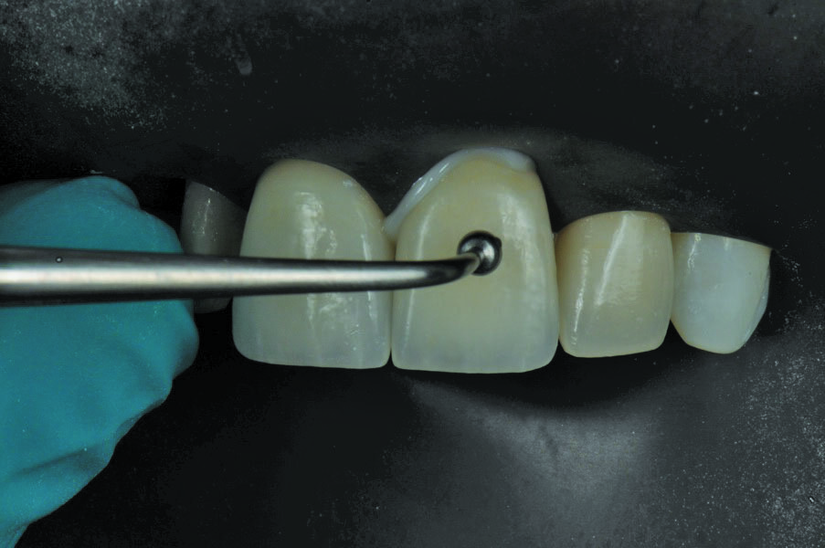 Fig. 19: Each veneer is carefully placed under slight pressure to extrude the excess. A 20 second spot light cure away from the margin is recommended to ensure a stabilized restoration in place prior to cleaning up the excess. Final cure for 30 seconds from all surfaces.
