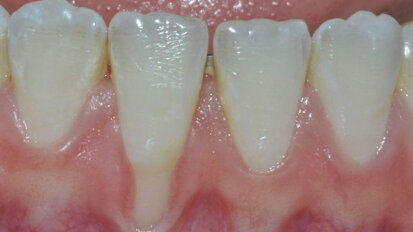 Chirurgia plastica parodontale opzioni terapeutiche nel trattamento estetico delle recessioni gengivali