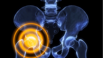 Rare fratture atipiche del femore. Un effetto di classe dei bisfosfonati