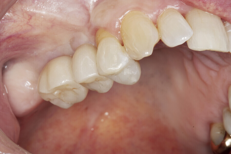 Fig. 17: Screw access holes sealed and amalgam in tooth #14 replaced with composite.