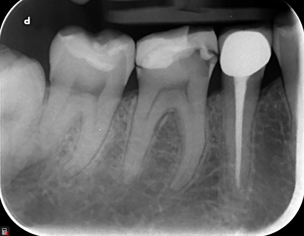 Fig. 1b: Radiographic view of tooth #46 showing the old composite restoration and the extent of the carious lesion.