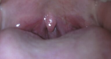 Laserowe leczenie chrapania i bezdechu sennego