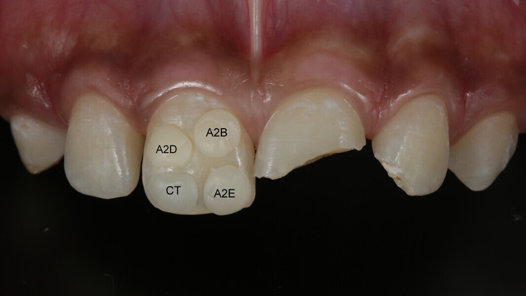 Fig 3: Shade was evaluated with the “Button technique”. A2 Dentin was used for inner layer and incisal halo, A2 Body for mid layer, Clear Translucent for opalescence and A2 Enamel for outer layer.