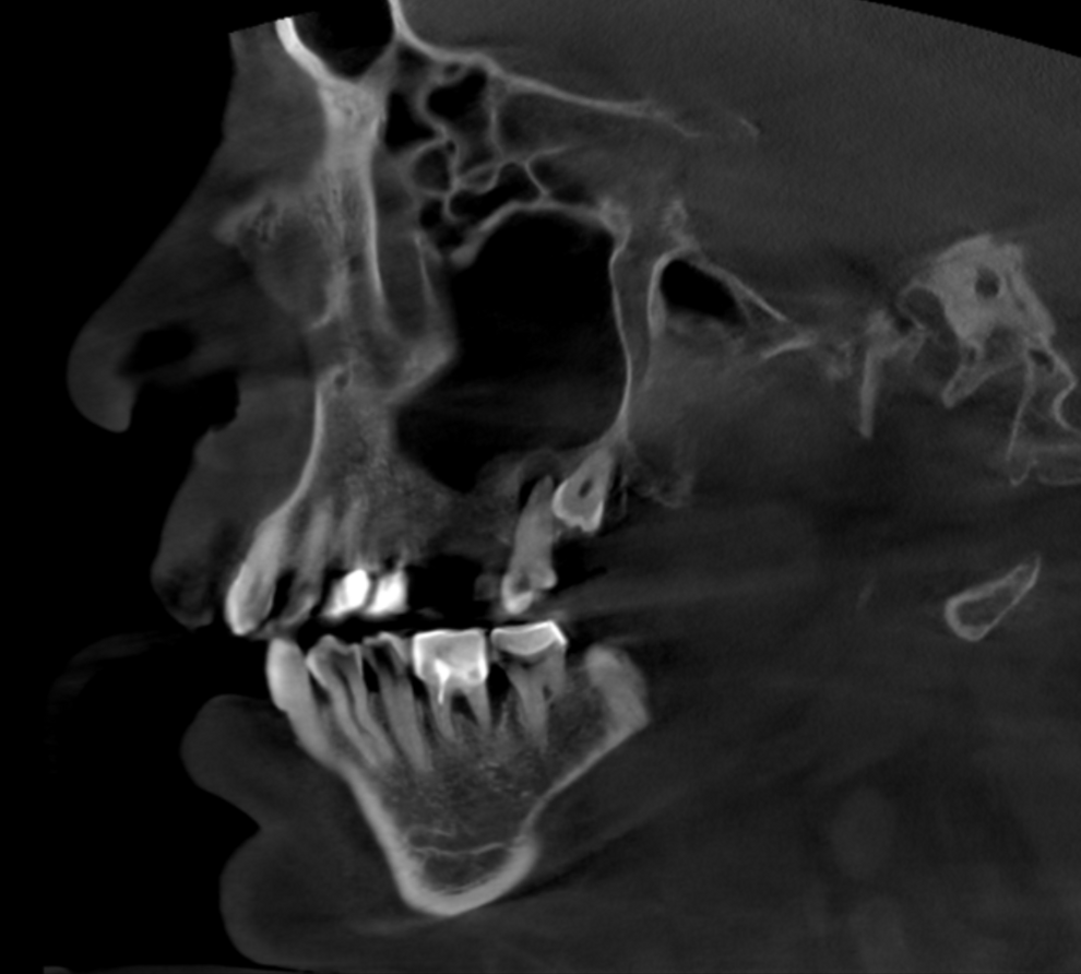 Fig. 6: Large-volume CBCT scan, sagittal cross-section during healing before the third treatment session.