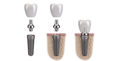 Zahnersatz als Allergieauslöser