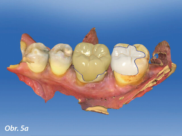CAD výroba v dolní čelisti.