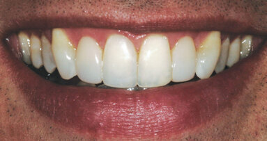 A banker’s bond: When less is more